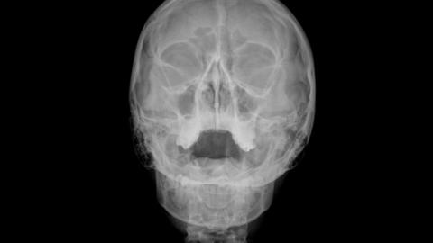 Orbital X-ray